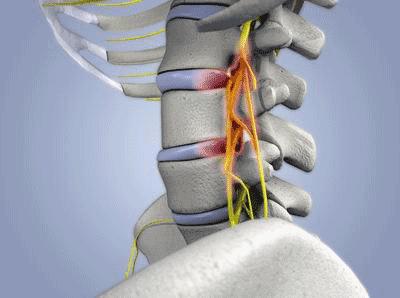 腰椎间盘突出最新疗法，探索创新治疗途径